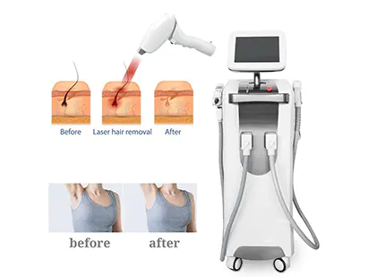 808+nd yag laser hair removal